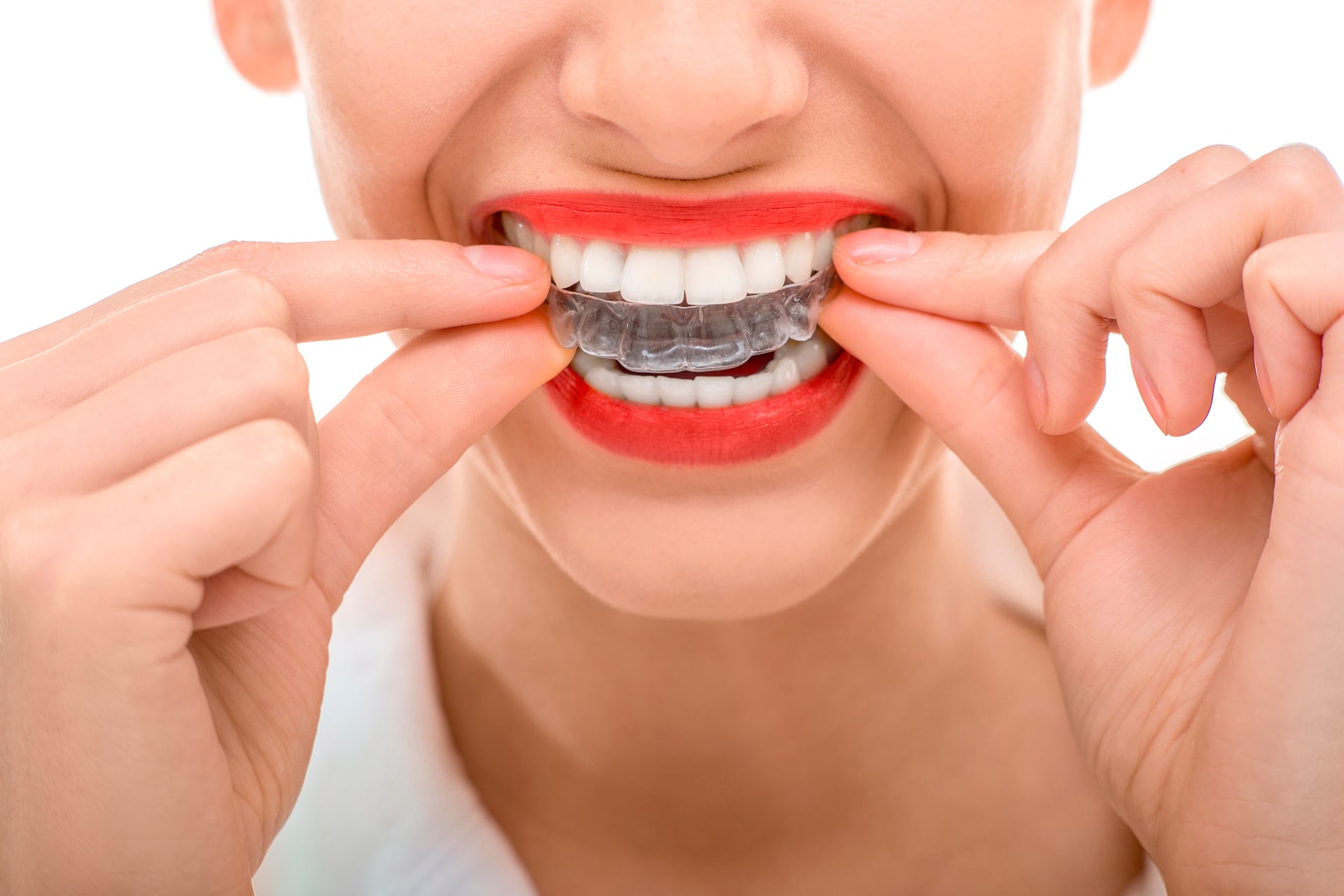 Orthodontie invisible
