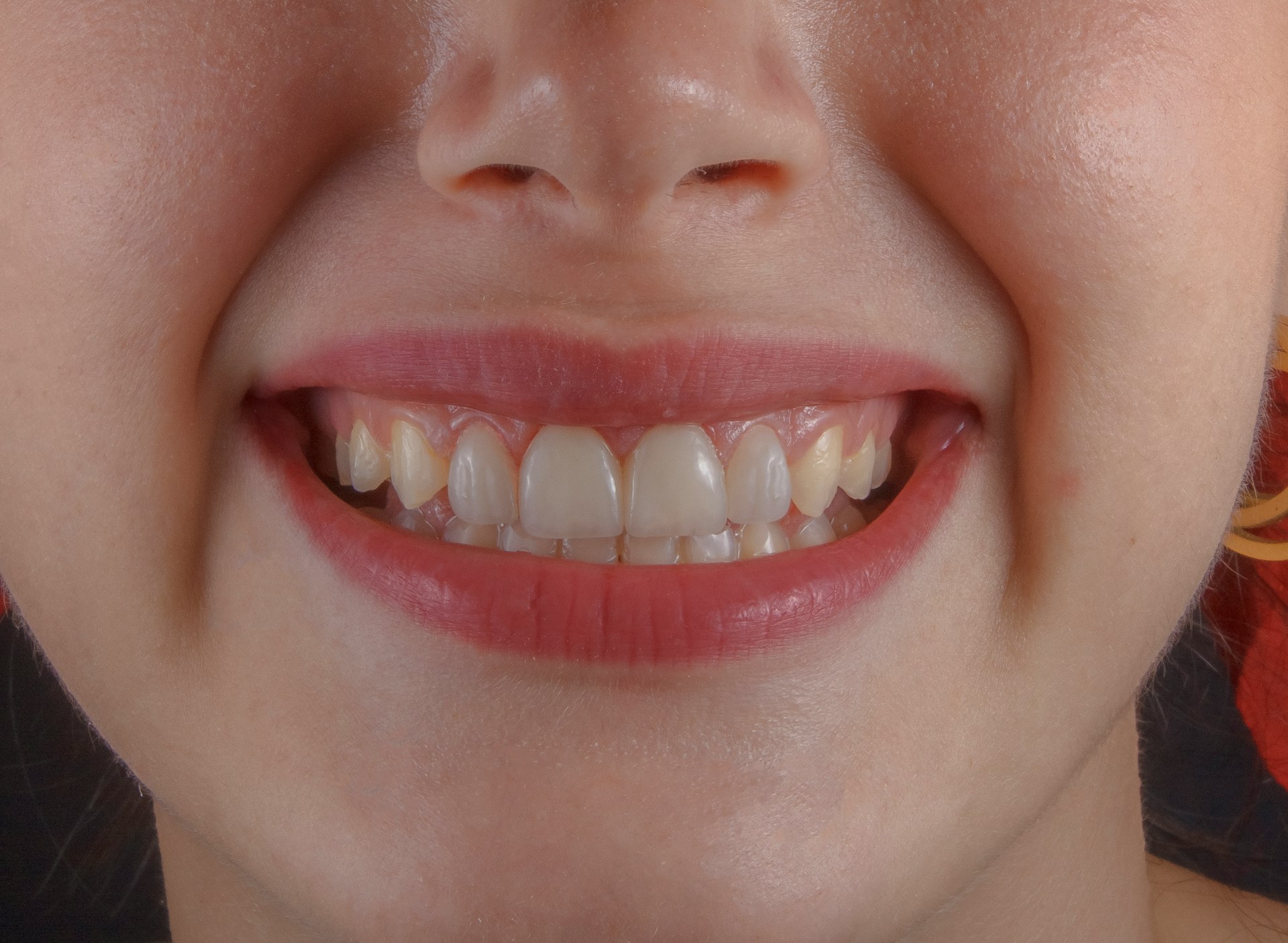 Pourquoi vos dents deviennent-elles sensibles après un détartrage ?